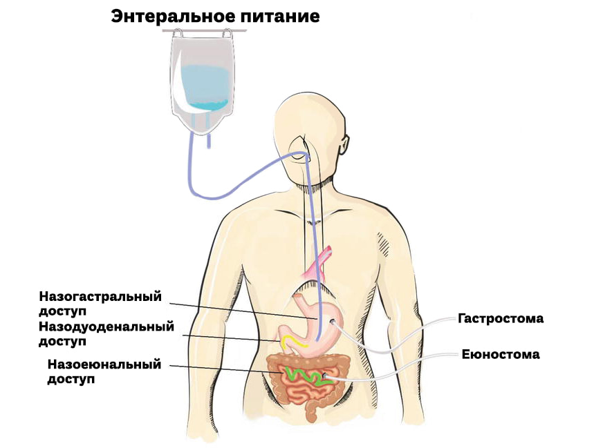 enteralnoe-pitanie.jpg